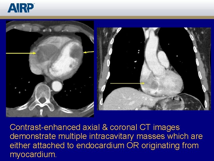 Contrast-enhanced axial & coronal CT images demonstrate multiple intracavitary masses which are either attached