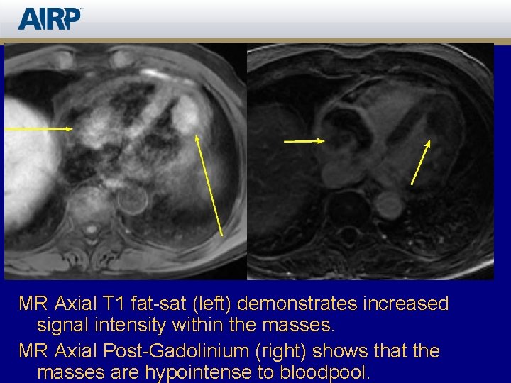 MR Axial T 1 fat-sat (left) demonstrates increased signal intensity within the masses. MR