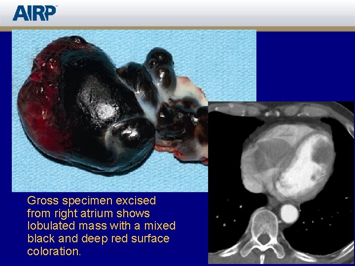 Gross specimen excised from right atrium shows lobulated mass with a mixed black and