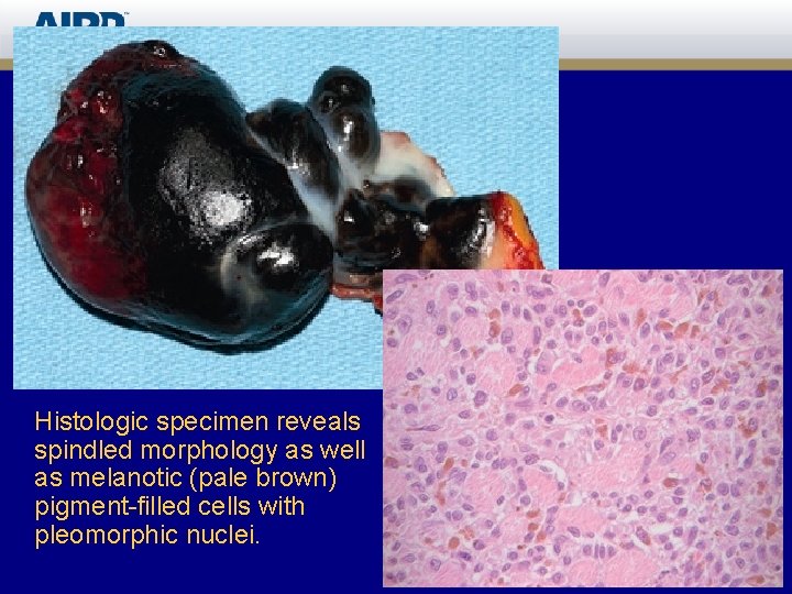 Histologic specimen reveals spindled morphology as well as melanotic (pale brown) pigment-filled cells with