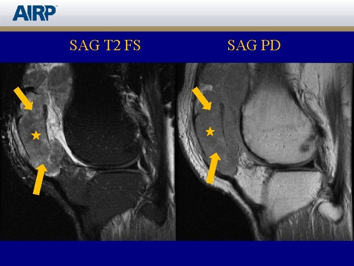 SAG T 2 FS SAG PD 