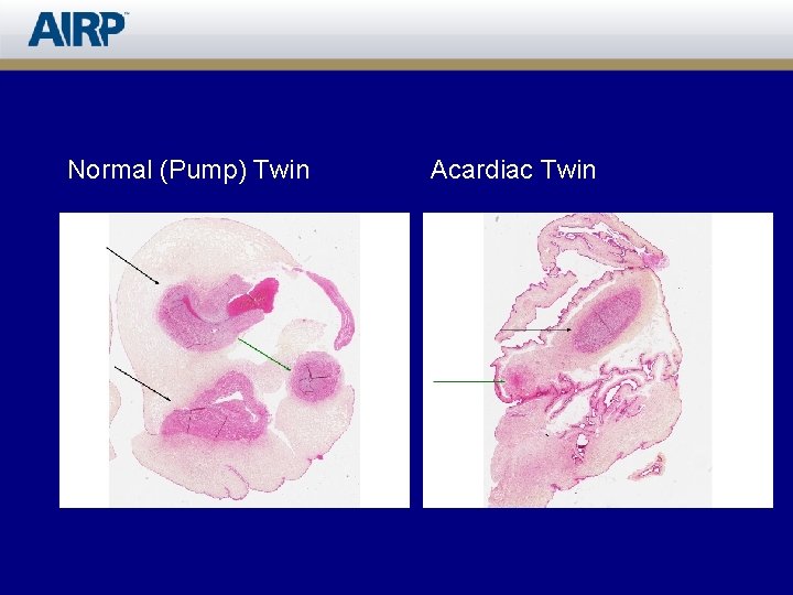 Normal (Pump) Twin Acardiac Twin 