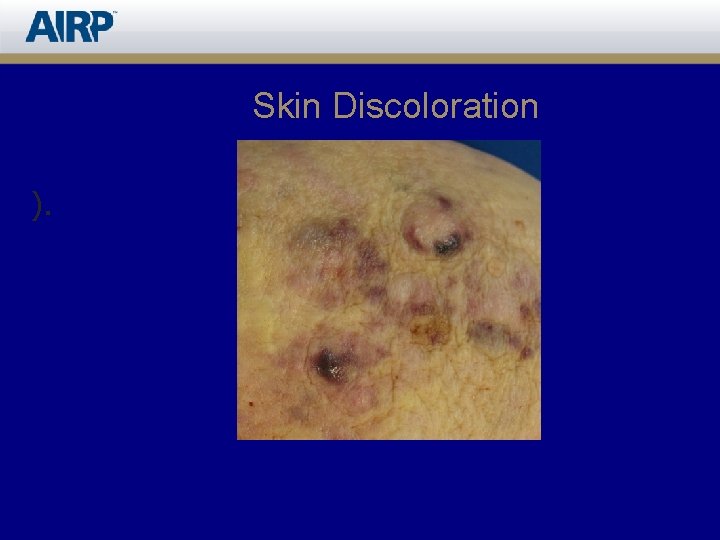 Skin Discoloration ). 