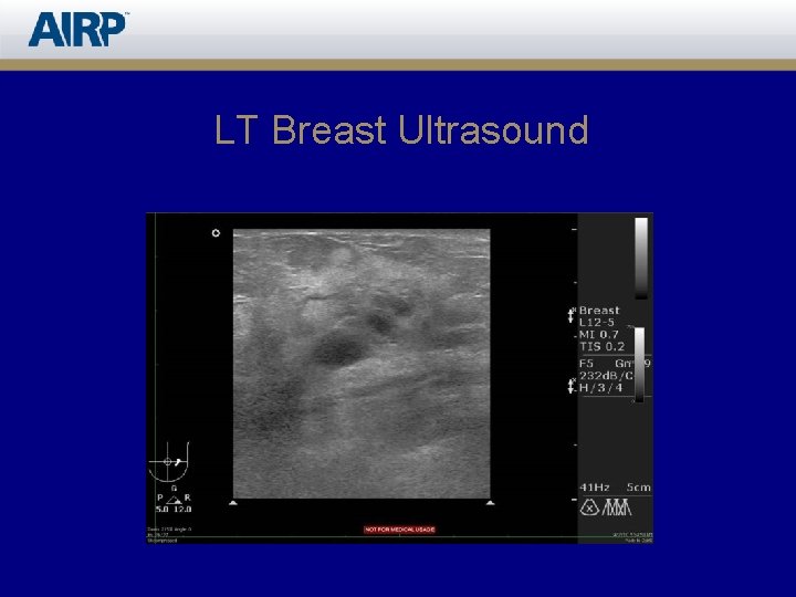 LT Breast Ultrasound 