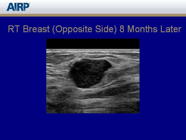 RT Breast (Opposite Side) 8 Months Later 