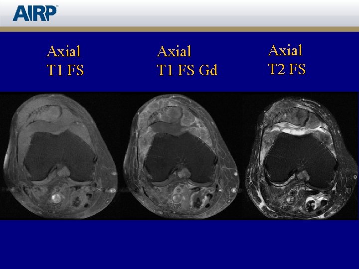 Axial T 1 FS Gd Axial T 2 FS 