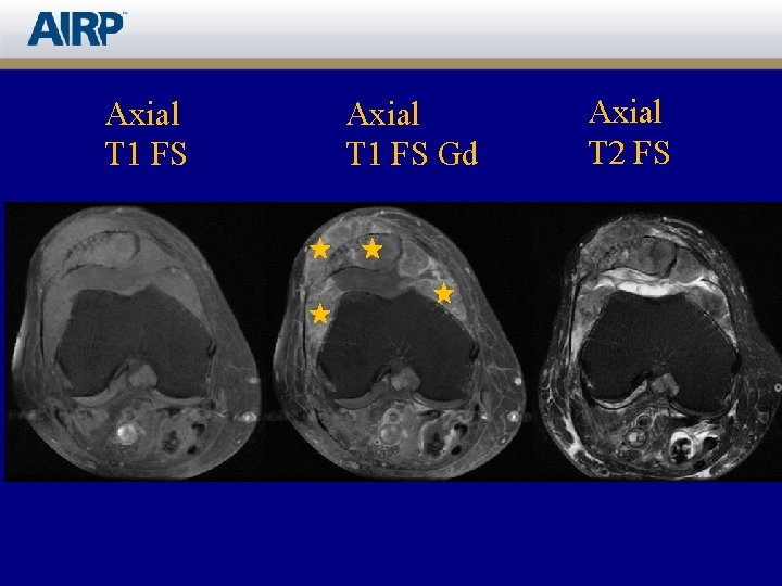 Axial T 1 FS Gd Axial T 2 FS 