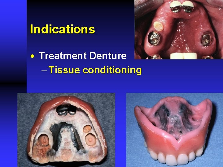 Indications · Treatment Denture - Tissue conditioning 