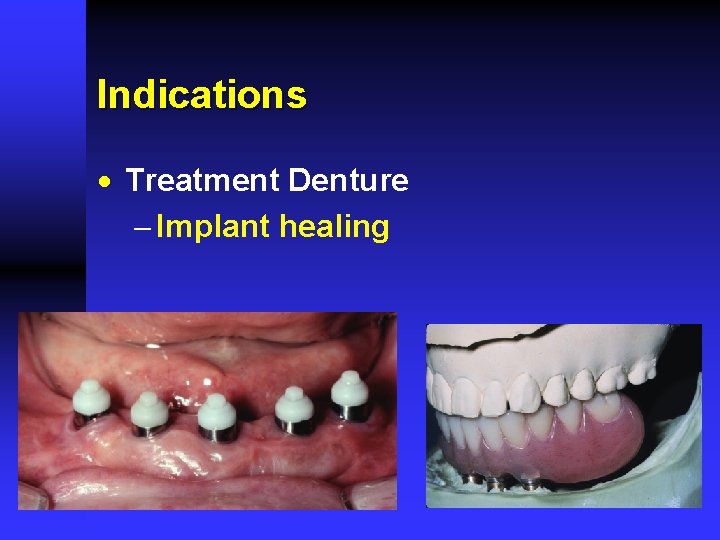 Indications · Treatment Denture - Implant healing 
