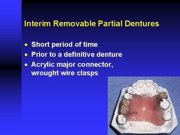 Interim Removable Partial Dentures · Short period of time · Prior to a definitive