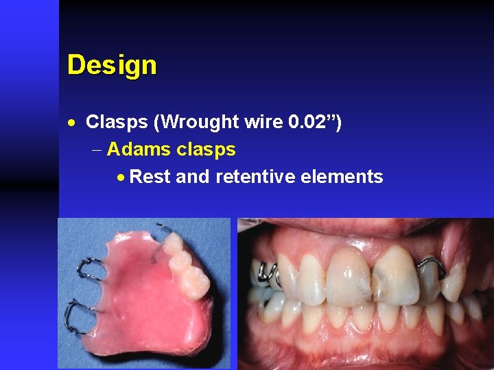 Design · Clasps (Wrought wire 0. 02”) - Adams clasps · Rest and retentive