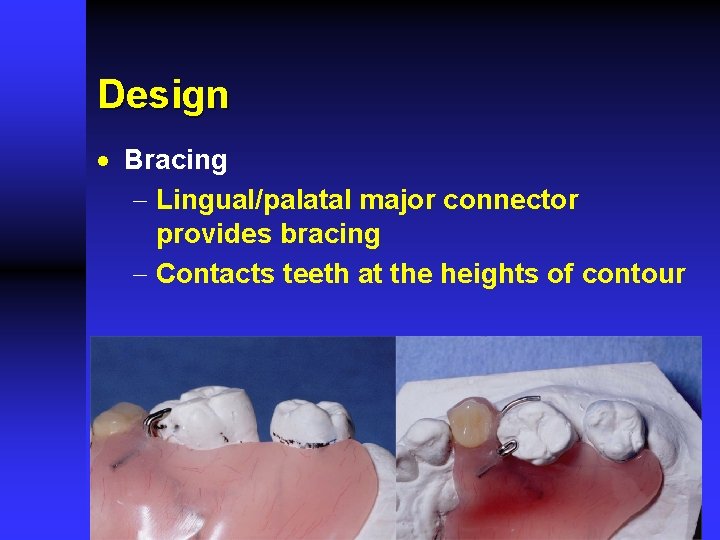 Design · Bracing - Lingual/palatal major connector provides bracing - Contacts teeth at the