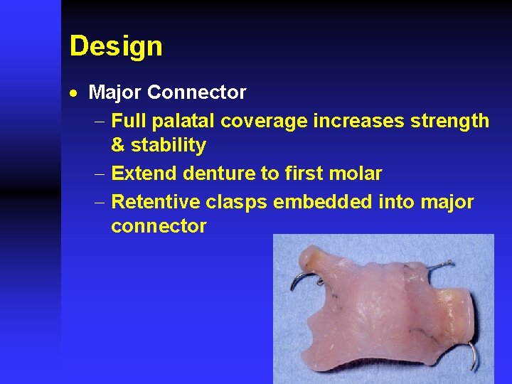 Design · Major Connector - Full palatal coverage increases strength & stability - Extend