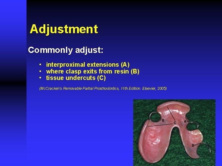 Adjustment Commonly adjust: • interproximal extensions (A) • where clasp exits from resin (B)