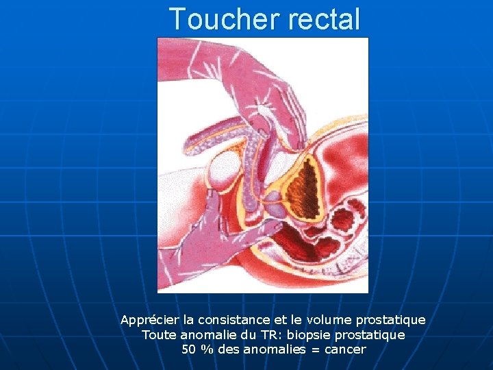 Toucher rectal Apprécier la consistance et le volume prostatique Toute anomalie du TR: biopsie