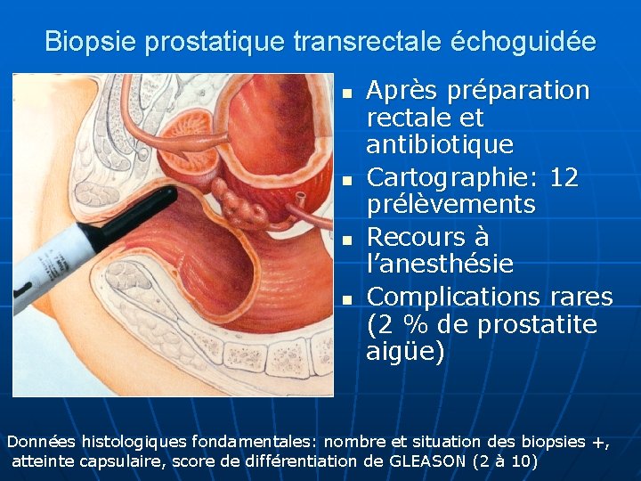 Biopsie prostatique transrectale échoguidée n n Après préparation rectale et antibiotique Cartographie: 12 prélèvements