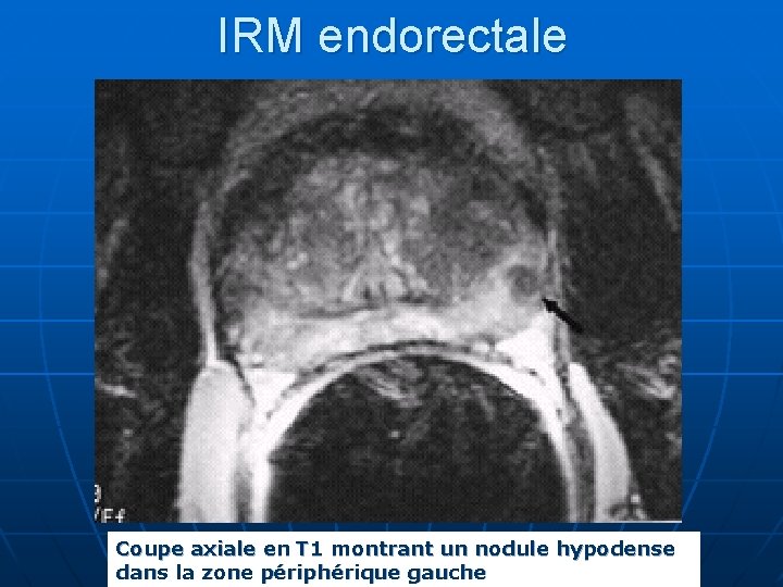 IRM endorectale Coupe axiale en T 1 montrant un nodule hypodense dans la zone