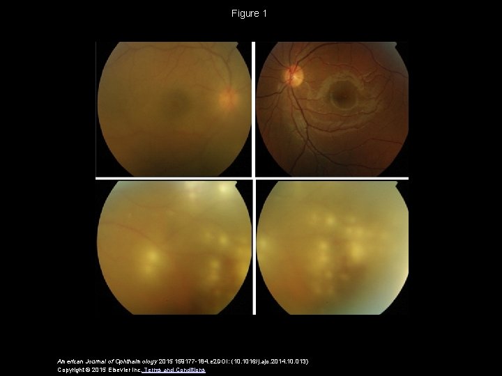 Figure 1 American Journal of Ophthalmology 2015 159177 -184. e 2 DOI: (10. 1016/j.