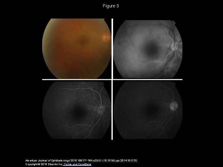 Figure 3 American Journal of Ophthalmology 2015 159177 -184. e 2 DOI: (10. 1016/j.