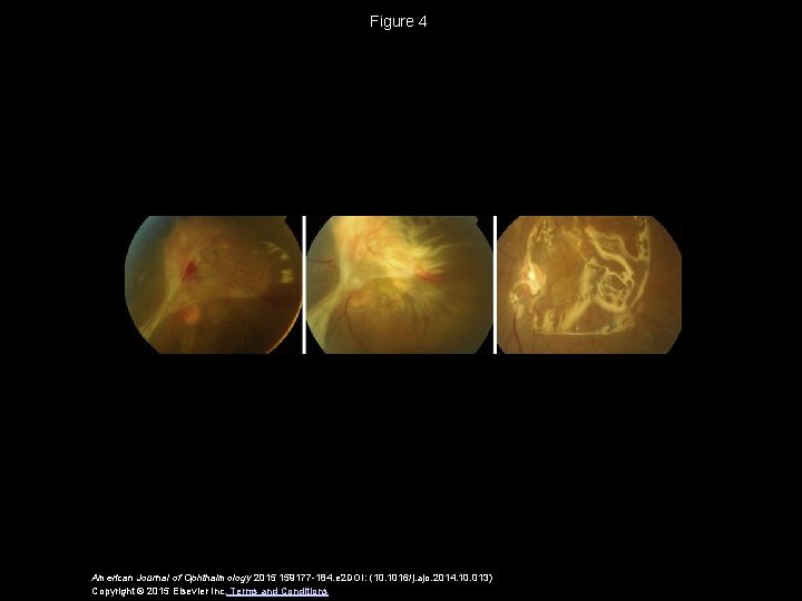 Figure 4 American Journal of Ophthalmology 2015 159177 -184. e 2 DOI: (10. 1016/j.