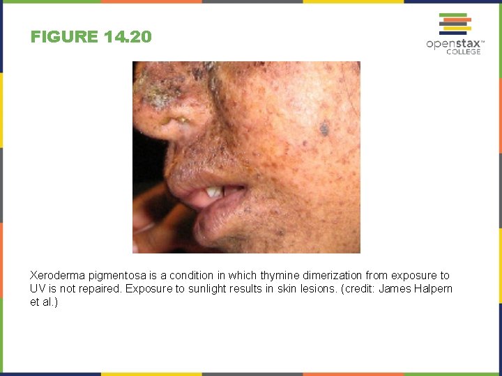 FIGURE 14. 20 Xeroderma pigmentosa is a condition in which thymine dimerization from exposure