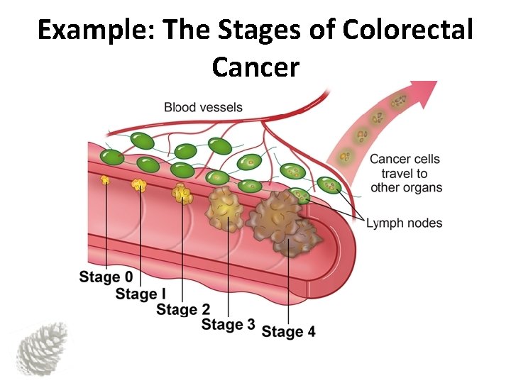 Example: The Stages of Colorectal Cancer 