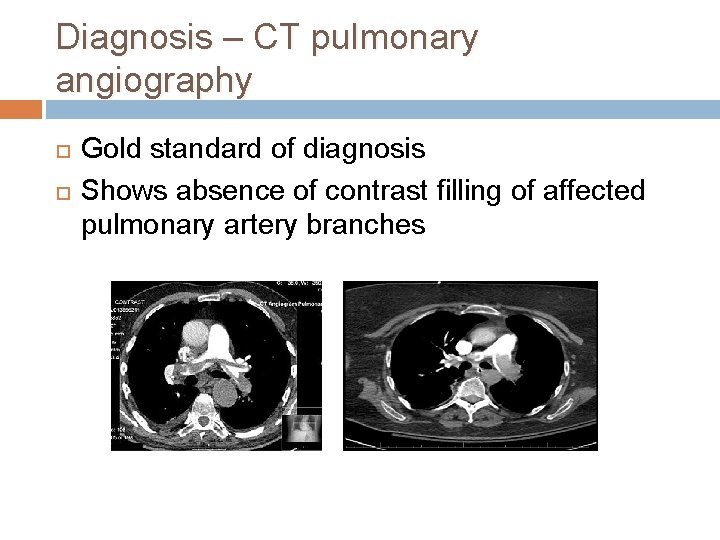 Diagnosis – CT pulmonary angiography Gold standard of diagnosis Shows absence of contrast filling