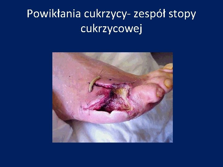 Powikłania cukrzycy- zespół stopy cukrzycowej 