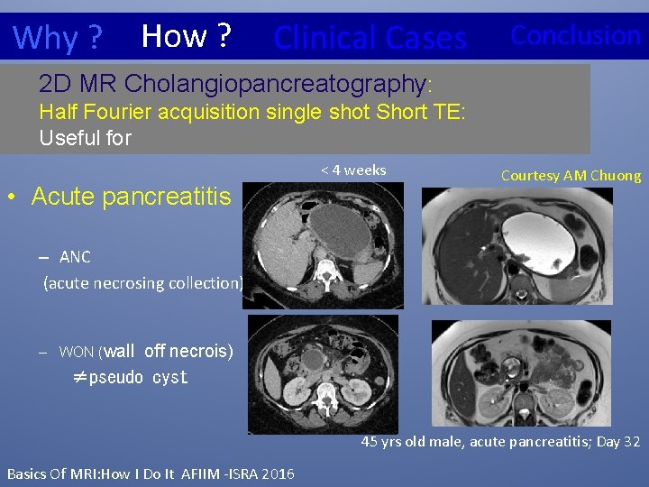 Why ? How ? Clinical Cases Conclusion 2 D MR Cholangiopancreatography: Half Fourier acquisition