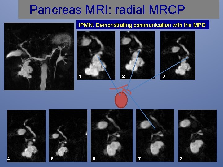 Pancreas MRI: radial MRCP IPMN: Demonstrating communication with the MPD 1 4 5 2