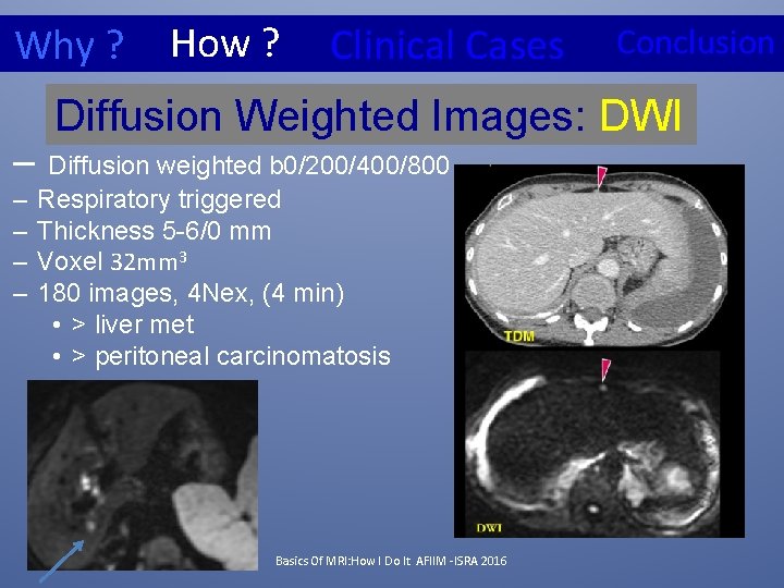 Why ? How ? Clinical Cases Conclusion Diffusion Weighted Images: DWI – Diffusion weighted