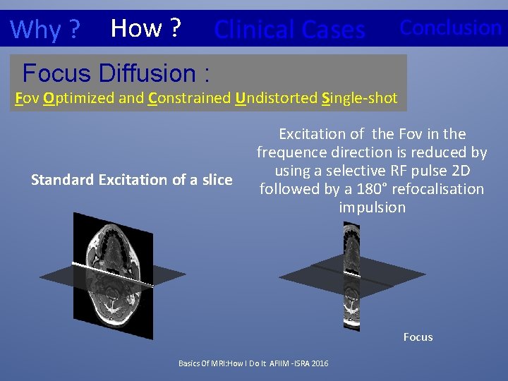 Why ? How ? Clinical Cases Conclusion Focus Diffusion : Fov Optimized and Constrained