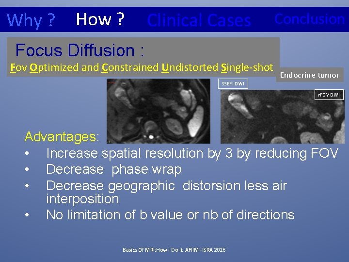 Why ? How ? Clinical Cases Conclusion Focus Diffusion : Fov Optimized and Constrained