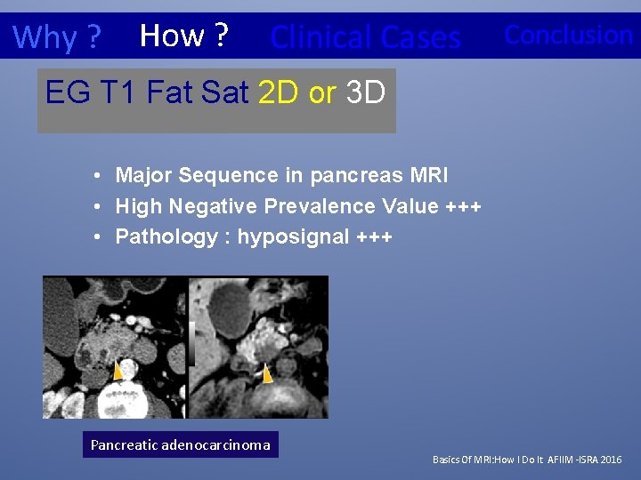 Why ? How ? Clinical Cases Conclusion EG T 1 Fat Sat 2 D