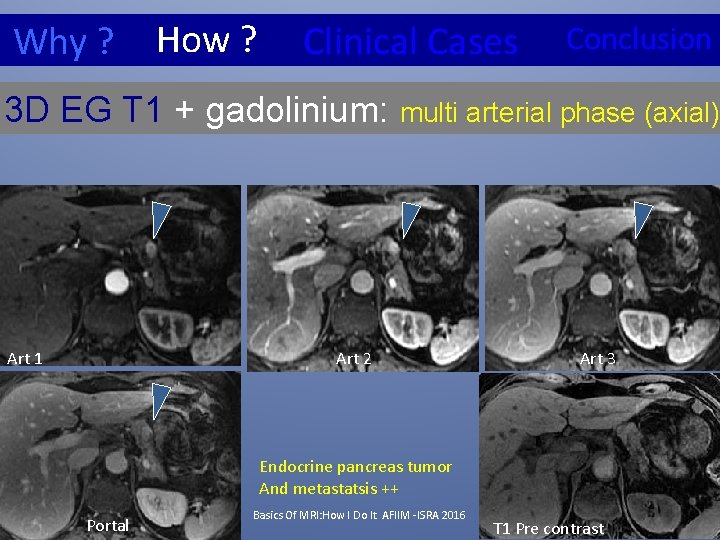How ? Why ? Clinical Cases Conclusion 3 D EG T 1 + gadolinium: