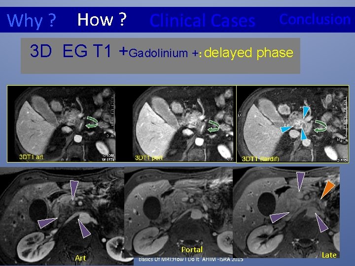 How ? Why ? Clinical Cases Conclusion 3 D EG T 1 +Gadolinium +:
