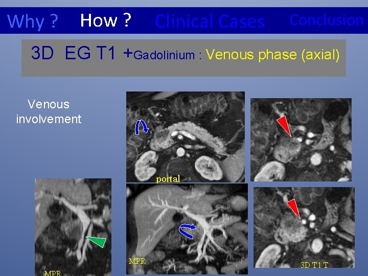 How ? Why ? Clinical Cases Conclusion 3 D EG T 1 +Gadolinium :