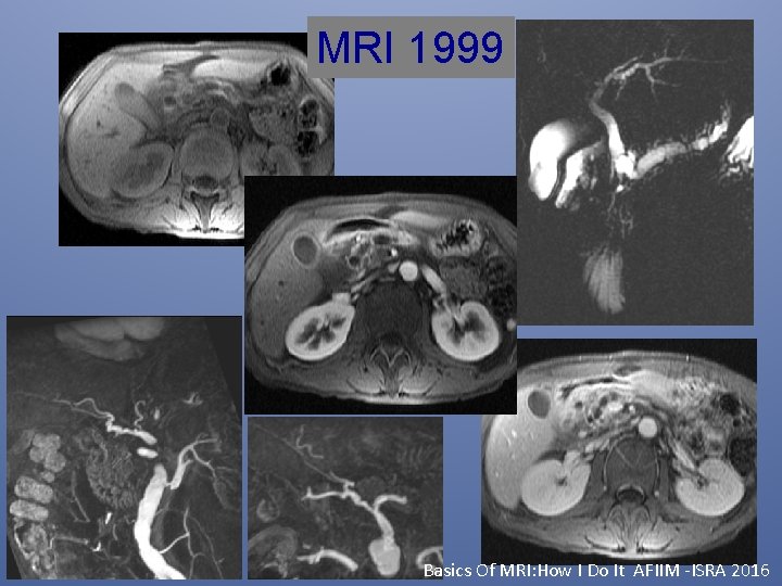 MRI 1999 Basics Of MRI: How I Do It AFIIM -ISRA 2016 