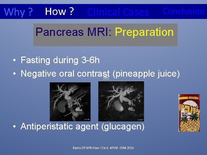 Why ? How ? Clinical Cases Conclusion Pancreas MRI: Preparation • Fasting during 3