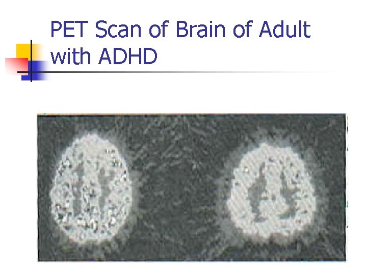 PET Scan of Brain of Adult with ADHD 