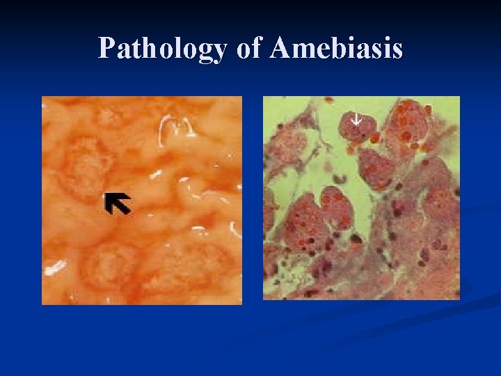  Pathology of Amebiasis 