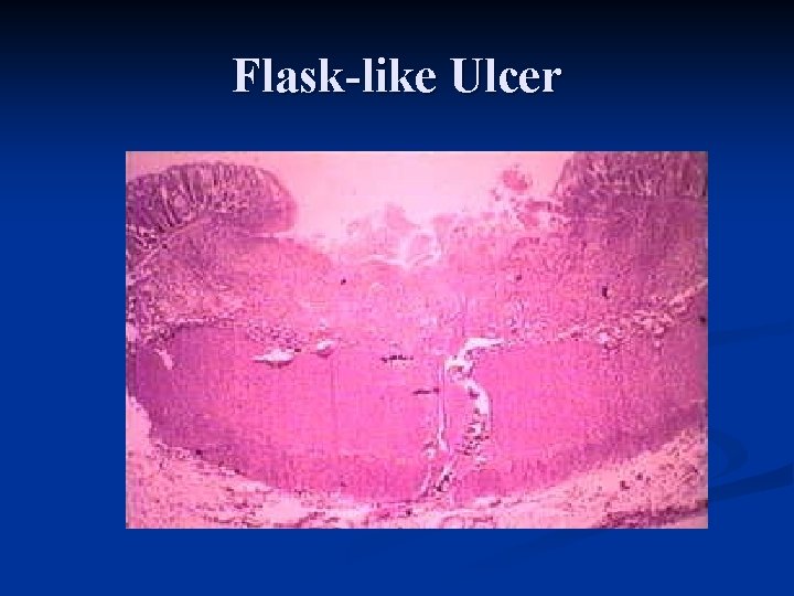 Flask-like Ulcer 
