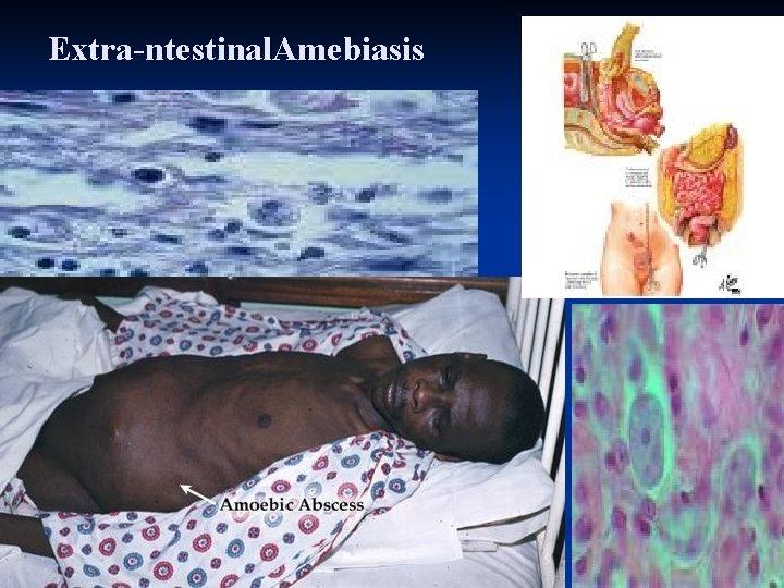 Extra-ntestinal. Amebiasis 