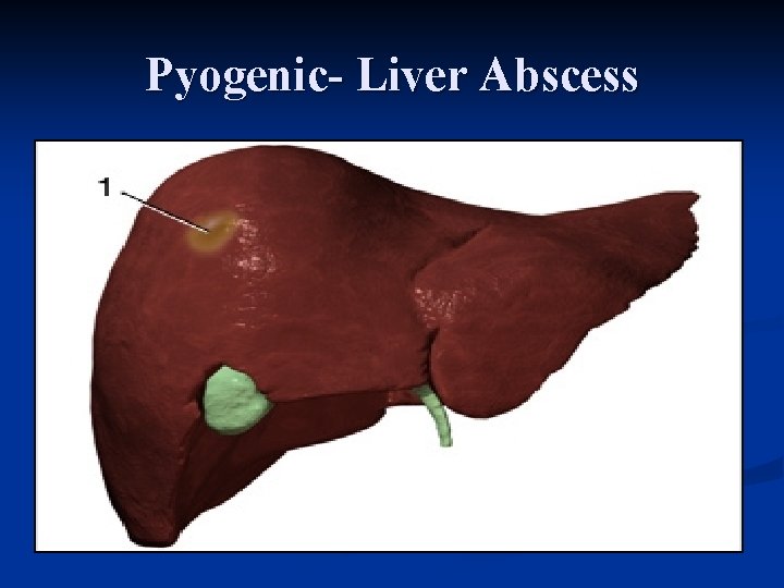 Pyogenic- Liver Abscess 