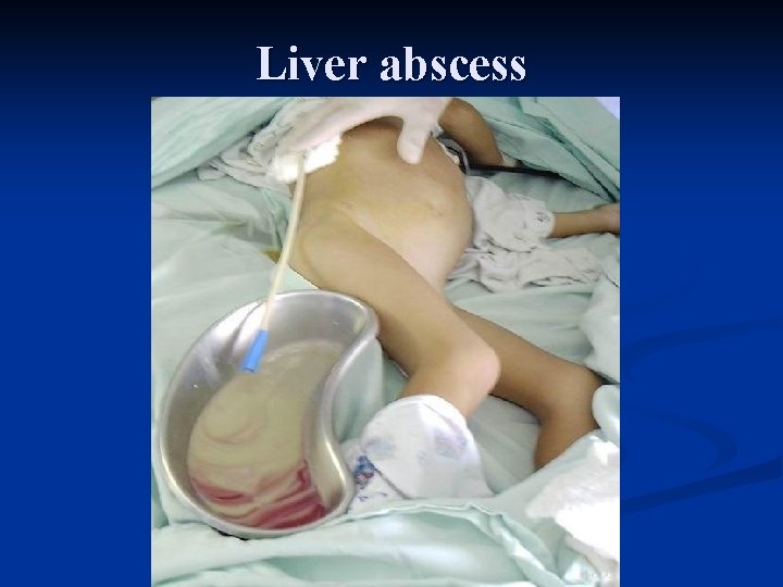Liver abscess 