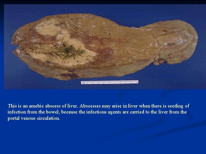 This is an amebic abscess of liver. Abscesses may arise in liver when there