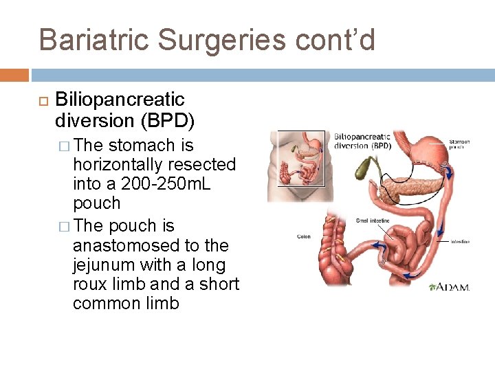 Bariatric Surgeries cont’d Biliopancreatic diversion (BPD) � The stomach is horizontally resected into a