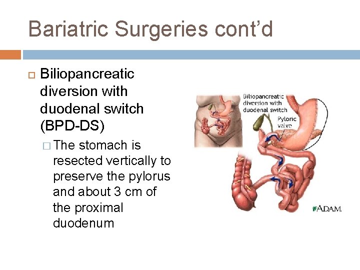 Bariatric Surgeries cont’d Biliopancreatic diversion with duodenal switch (BPD-DS) � The stomach is resected