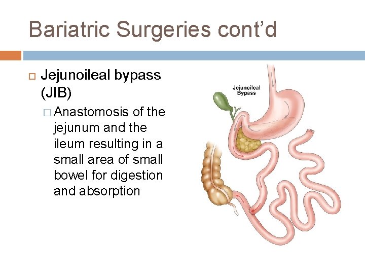 Bariatric Surgeries cont’d Jejunoileal bypass (JIB) � Anastomosis of the jejunum and the ileum