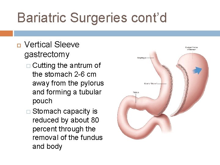 Bariatric Surgeries cont’d Vertical Sleeve gastrectomy � Cutting the antrum of the stomach 2